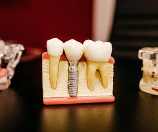 Crowns & Bridgework